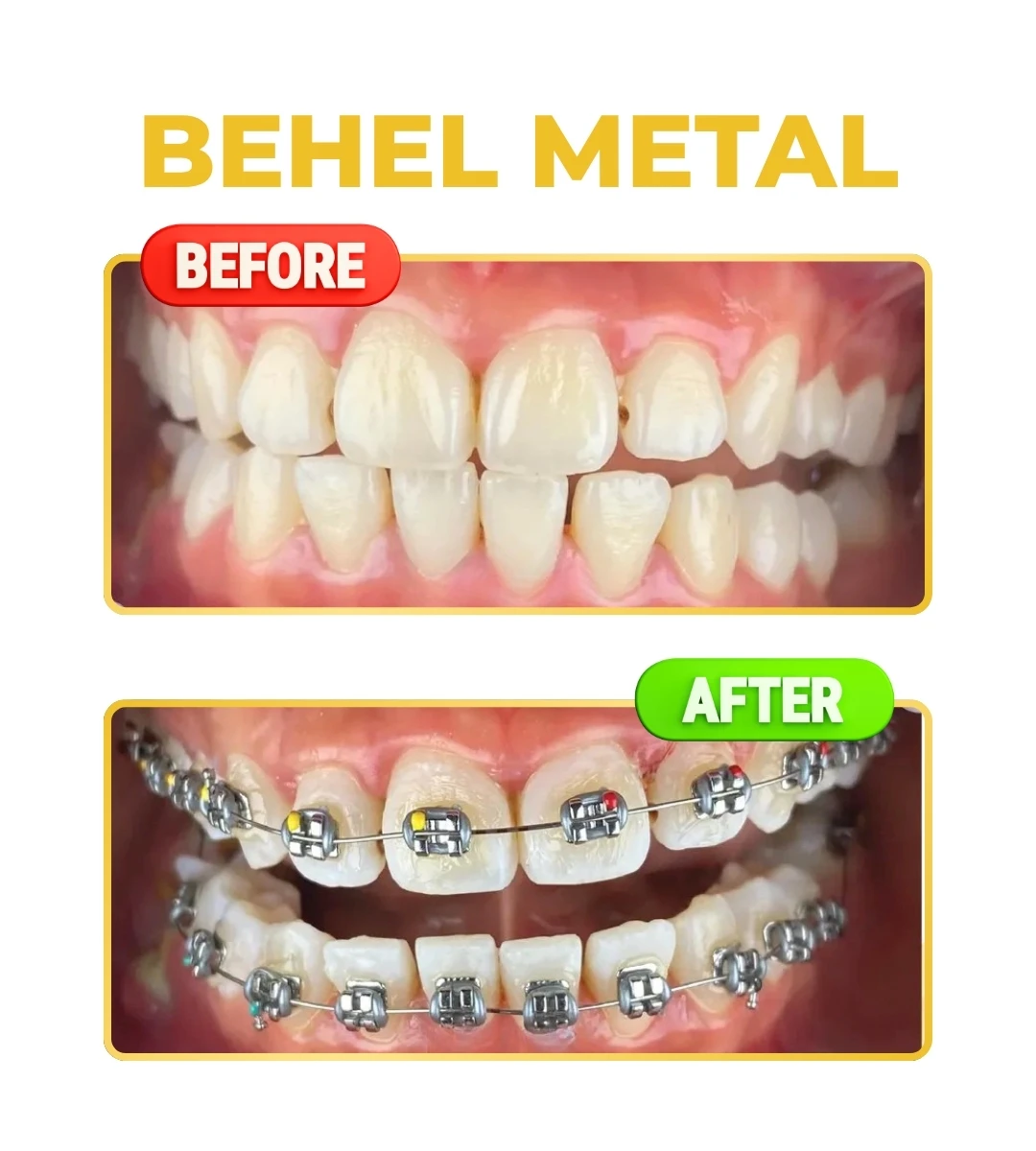 Behel Metal