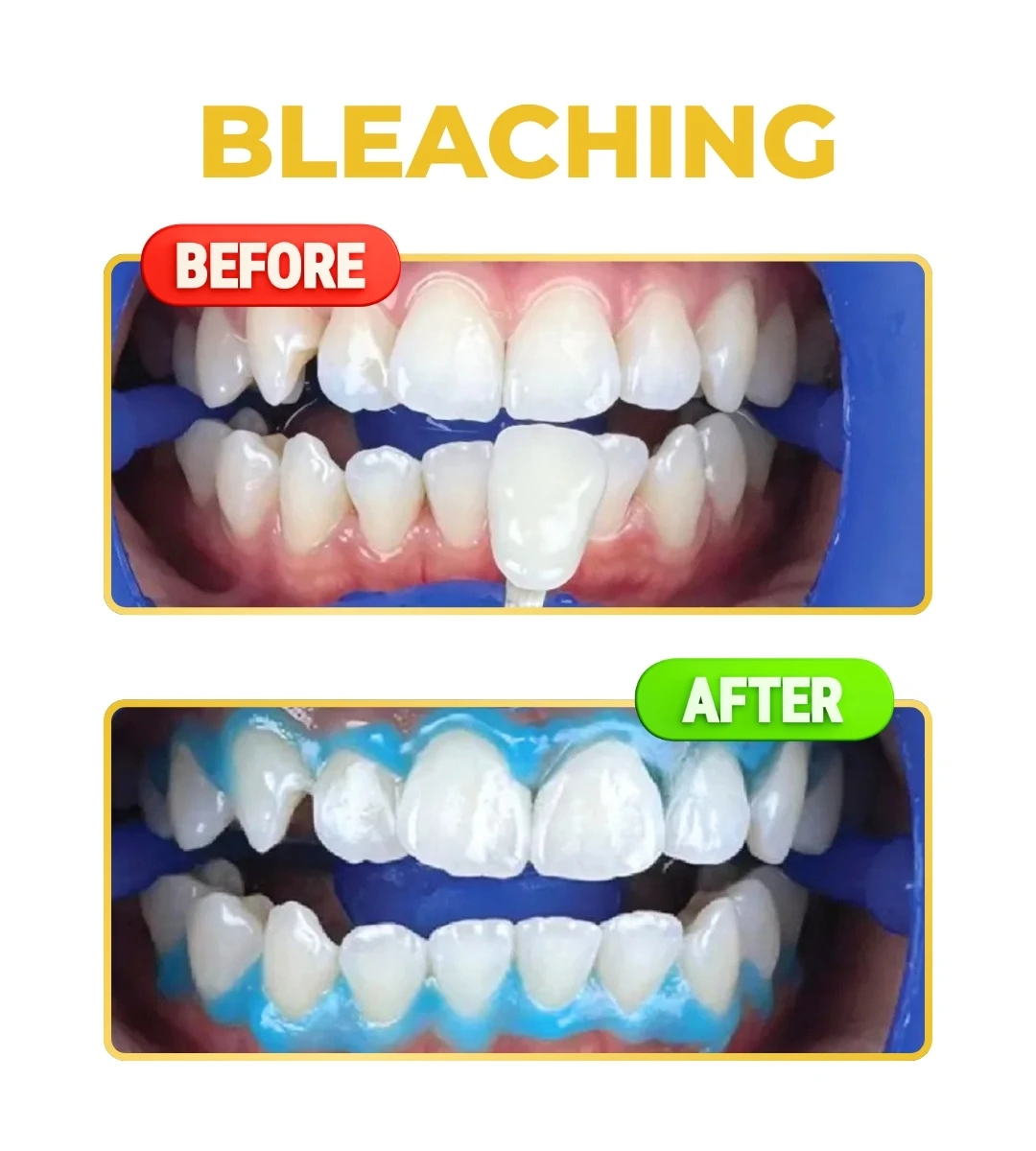bleaching gigi tangerang