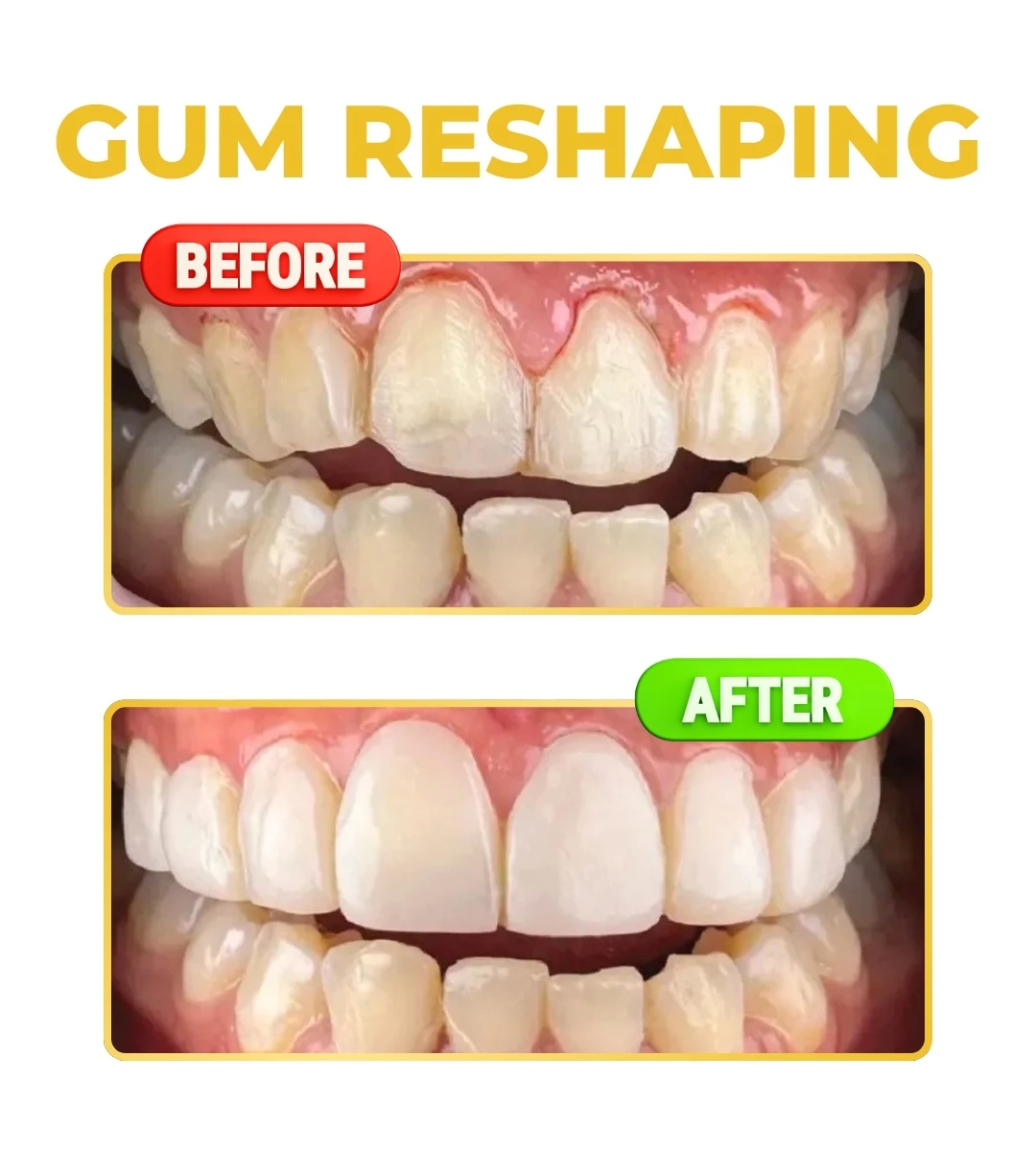 Klinik gigi aesthetic Tangerang bleaching gigi veneer Daven Dental Pasar Kemis